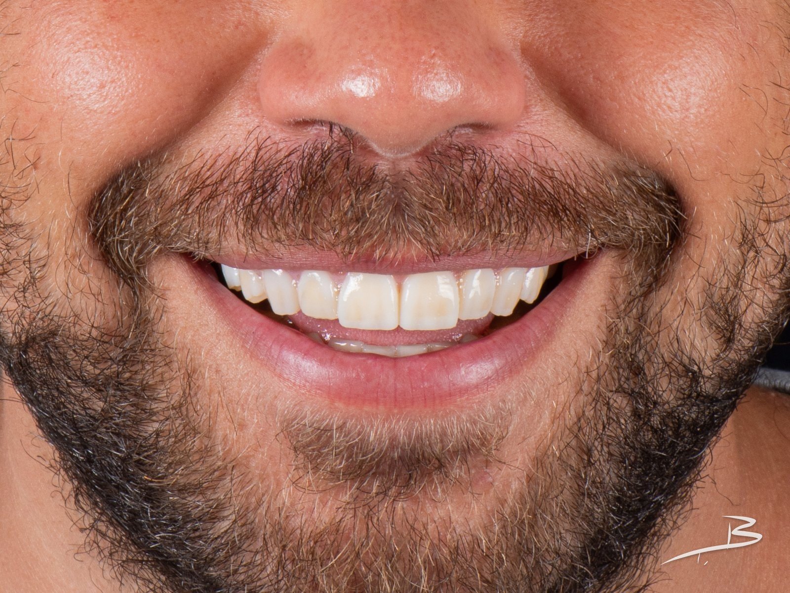 Estética dental digital – después