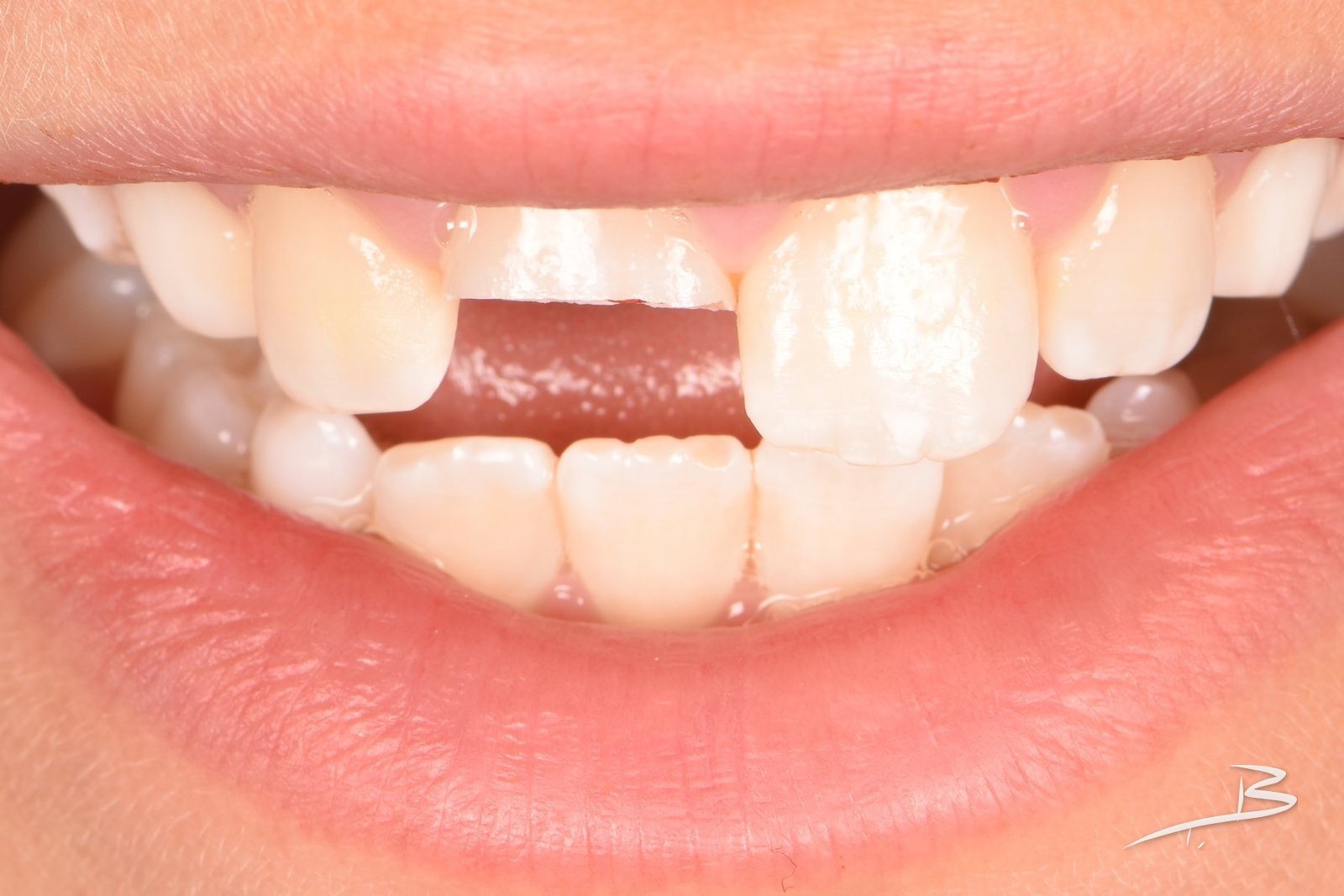 Sonrisa con el incisivo fracturado