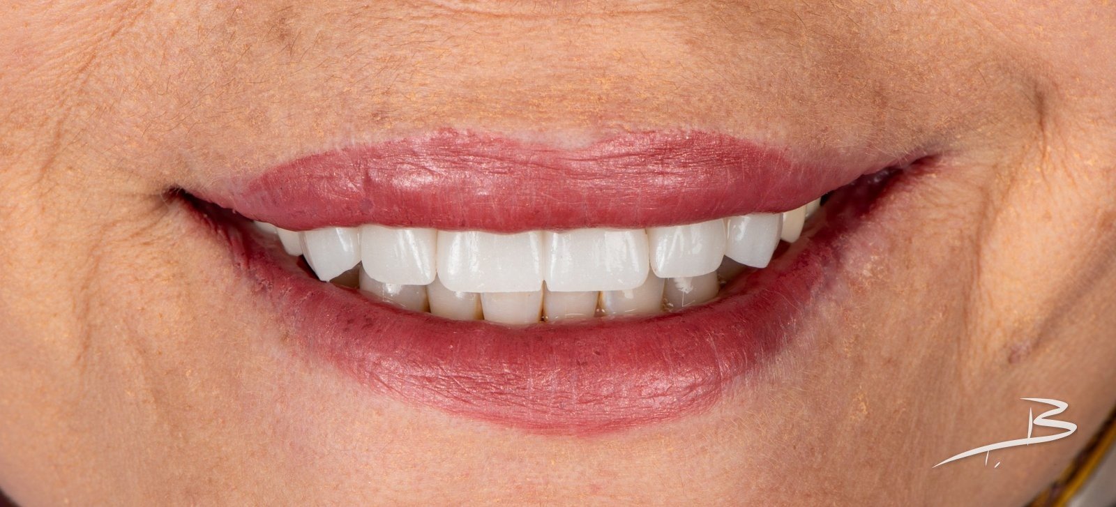 Sonrisa del paciente con las coronas definitivas