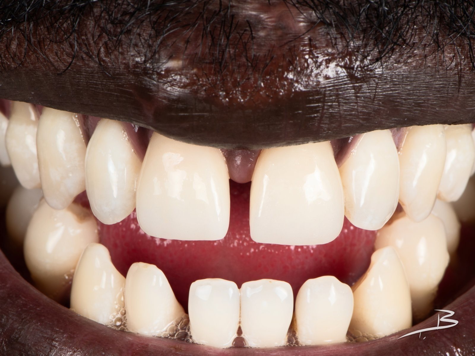 Traumatismo dental – después